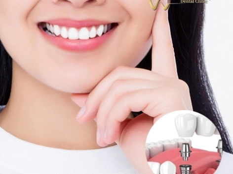Cấy ghép Implant