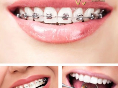 Niềng răng mắc cài