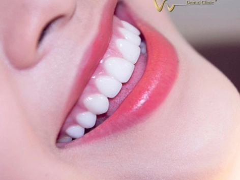 Bọc răng sứ thẩm mỹ