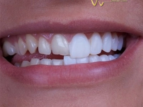 Dán sứ Veneer