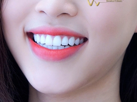 Tẩy trắng răng 2 hàm